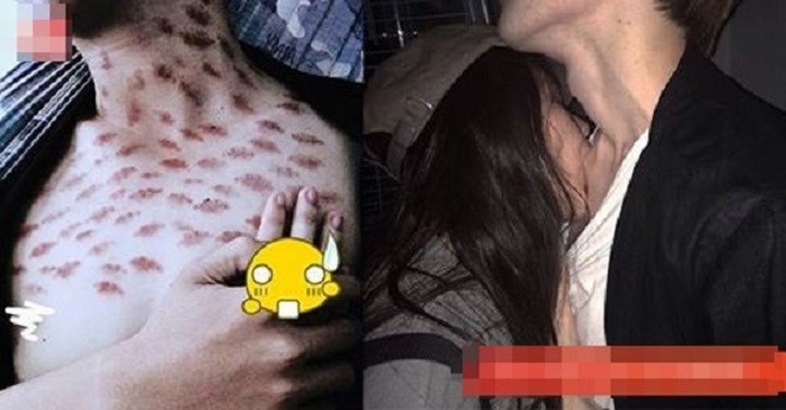 hình ảnh các vế bầm do hickey Hickey là gì
