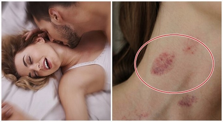 Cách tạo ra một Hickey kiss hoàn hảo và đẹp mắt Cách tạo ra một Hickey kiss hoàn hảo và đẹp mắt